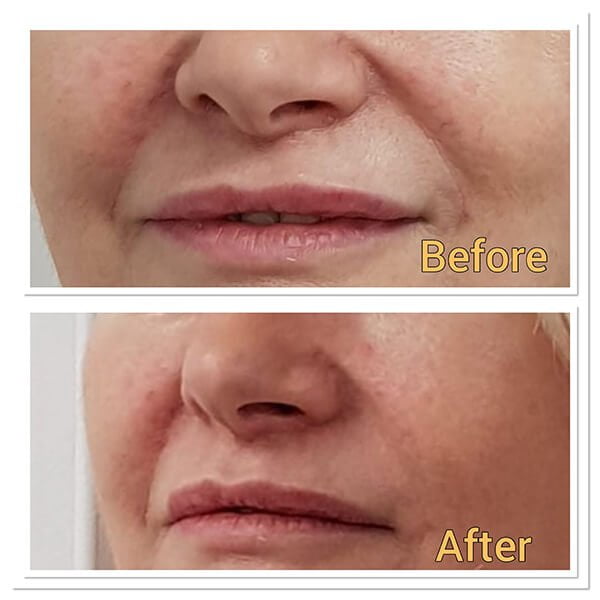 Facial Aesthetics Bournemouth Dermal Fillers Wallisdown